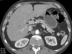 Implant on Liver Due to Carcinoid Tumor - CTisus CT Scan