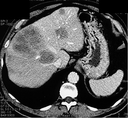 Hepatoma- Multifocal - CTisus CT Scan