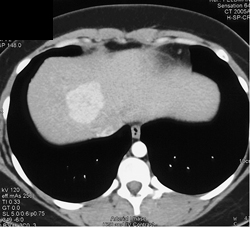 Focal Nodular Hyperplasia (FNH) - CTisus CT Scan