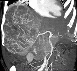 Hepatoma With Neovascularity - CTisus CT Scan