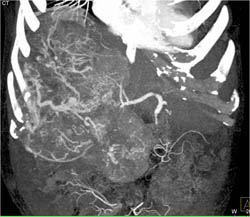 Hepatoma With Neovascularity - CTisus CT Scan