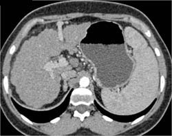 Cirrhosis With Recanalized Umbilical Vein - CTisus CT Scan