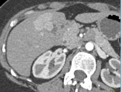 Focal Nodular Hyperplasia (FNH) - CTisus CT Scan