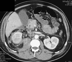Liver Metastases - CTisus CT Scan