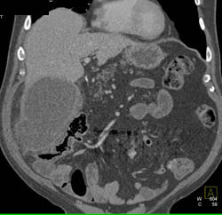 Acute Cholecystitis - CTisus CT Scan