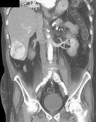 Metastatic Islet Cell Tumor - CTisus CT Scan
