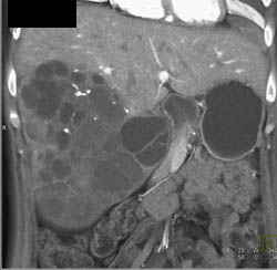 Biliary Cystadenocarcinoma - CTisus CT Scan