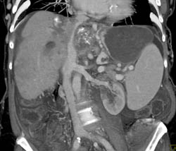 Tumor Near Abdominal Aorta - CTisus CT Scan