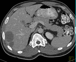 Liver Abscess - CTisus CT Scan