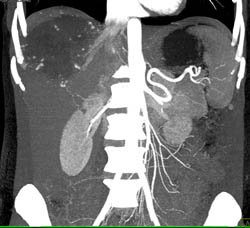 Giant Hemangioma - CTisus CT Scan