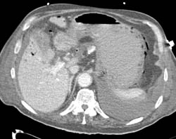 Portal Venous Air Due to Ischemic Bowel- Air in Gastric Wall Also Seen - CTisus CT Scan