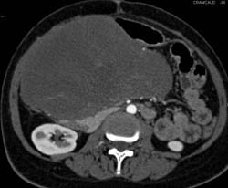 Desmoid Tumor Compresses the Liver - CTisus CT Scan