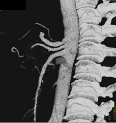 Hepatic and Splenic Arteries Arise Directly Off the Aorta - CTisus CT Scan