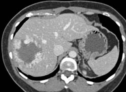 Giant Cavernous Hemangioma - CTisus CT Scan