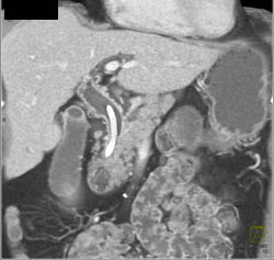 Distal Common Bile Duct (CBD) Dilation With Stent Due to Pancreatic Cancer - CTisus CT Scan