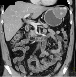 Hepatic Hemangioma Simulates A GIST Tumor of the Stomach- See Full Sequence of Images - CTisus CT Scan