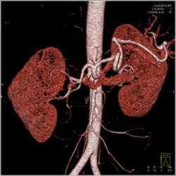Common Trunk to Superior Mesenteric Artery (SMA) and Celiac Artery - CTisus CT Scan