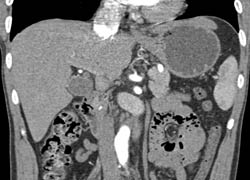 Stone in Distal Common Bile Duct (CBD) - CTisus CT Scan