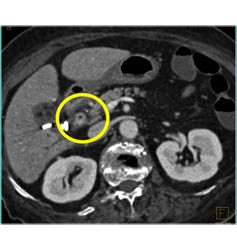 Cholangiocarcinoma of the Distal Common Bile Duct (CBD) Which Is Enhancing- See Full Sequence - CTisus CT Scan
