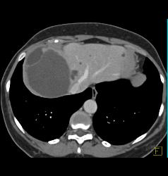 Multiple Hepatic Cysts - CTisus CT Scan