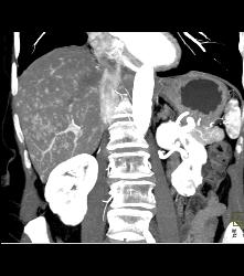 Vascular Metastases Due to Carcinoid Tumor - CTisus CT Scan