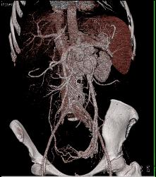 Cirrhosis With Huge Varices and Dilated Gonadal Vein - CTisus CT Scan
