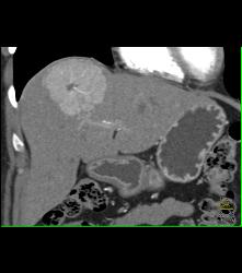 Focal Nodular Hyperplasia (FNH) With Central Scar and Feeding Vessel - CTisus CT Scan