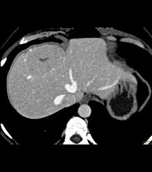 Focal Nodular Hyperplasia (FNH) With Central Scar and Feeding Vessel - CTisus CT Scan