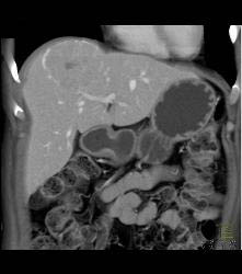Focal Nodular Hyperplasia (FNH) With Central Scar and Feeding Vessel - CTisus CT Scan
