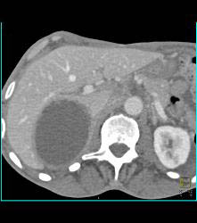 Necrotic Hepatocellular Carcinoma (Hepatoma) - CTisus CT Scan