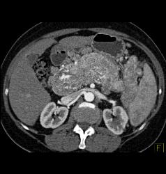Islet Cell Tumor of the Pancreas With Arterial Collaterals and Tumor Invasion of Portal Vein With Huge Collaterals - CTisus CT Scan