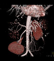 Hepatocellular Carcinoma (Hepatoma) - See All Phases of This Tumor - CTisus CT Scan