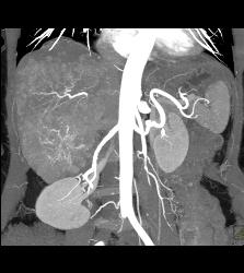 Hepatocellular Carcinoma (Hepatoma) - See All Phases of This Tumor - CTisus CT Scan