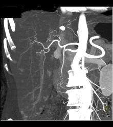 Multifocal Carcinoid Metastases - CTisus CT Scan