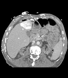 SVC Occlusion With Hot Spot Liver and Extensive Collaterals - CTisus CT Scan