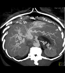 Hepatic Arteriovenous Malformations (AVMs) in A Patient With Pulmonary AVMs and Hereditary Hemorrhagic Telangiectasia (HHT) Syndrome - CTisus CT Scan