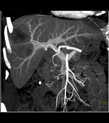 Metastatic Colon Cancer With Hypovascular Metastases - CTisus CT Scan