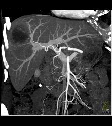 Metastatic Colon Cancer With Hypovascular Metastases - CTisus CT Scan