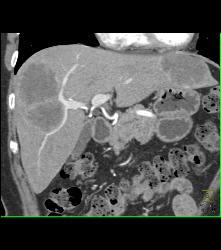 Metastatic Colon Cancer With Hypovascular Metastases - CTisus CT Scan