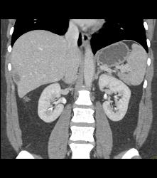 Perihepatic Fluid - CTisus CT Scan