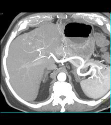 Hepatocellular Carcinoma (Hepatoma) - CTisus CT Scan