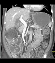 Hepatocellular Carcinoma (Hepatoma) - CTisus CT Scan