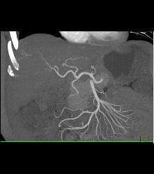 Subtle Blush for Hepatocellular Carcinoma (Hepatoma) - CTisus CT Scan