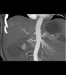 Subtle Blush for Hepatocellular Carcinoma (Hepatoma) - CTisus CT Scan