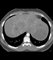 Kaposi Sarcoma in Liver and Spleen- Amazing - CTisus CT Scan