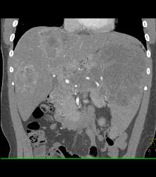 Kaposi Sarcoma in Liver and Spleen- Amazing - CTisus CT Scan