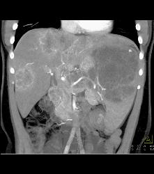 Kaposi Sarcoma in Liver and Spleen- Amazing - CTisus CT Scan