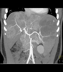 Kaposi Sarcoma in Liver and Spleen- Amazing - CTisus CT Scan
