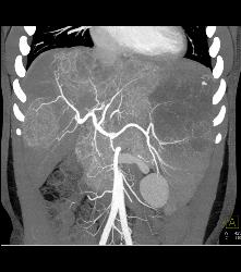 Kaposi Sarcoma in Liver and Spleen- Amazing - CTisus CT Scan