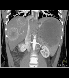 Kaposi Sarcoma in Liver and Spleen- Amazing - CTisus CT Scan